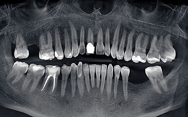Dental Cesium Iodide (CsI)